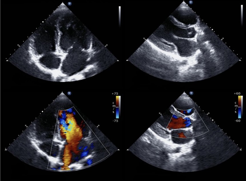 Ultraschallbilder Herzens mit Farbdopplerdarstellung bei der Echokardiografie