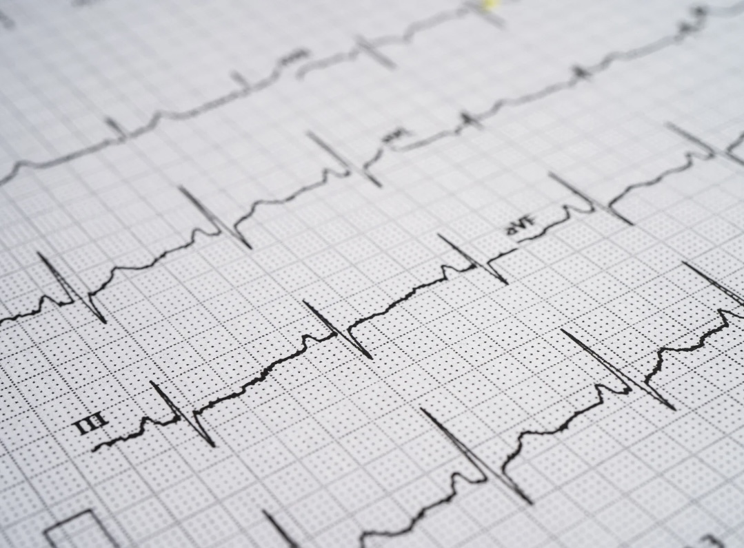 EKG-Kurven beim Belastungstest dargestellt