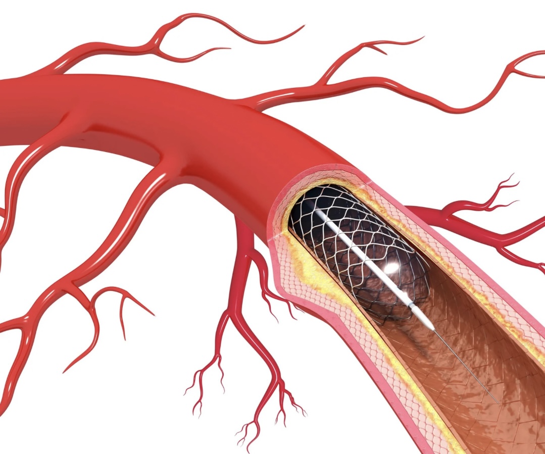 Einbringen eines Stents in ein Herzkranzgefäß mit einem Herzkatheter