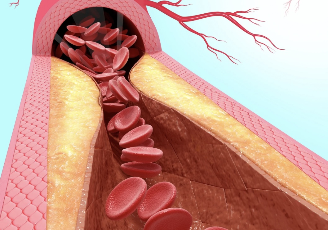 verengtes Blutgefäß mit Cholesterinablagerung und Behinderung des Blutflusses