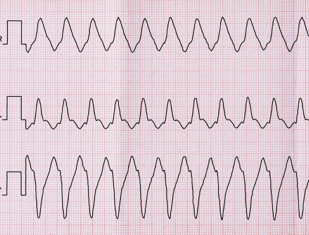 EKG-Ausdruck einer ventrikuläre Tachykardie als Indikation zur Katheterablation