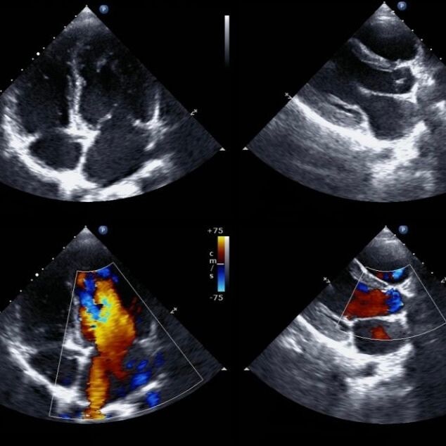 Ultraschallbilder des Herzens während einer Echokardiografie zur Beurteilung der Herzstruktur und -funktion, inklusive Farbdoppler zur Darstellung des Blutflusses.