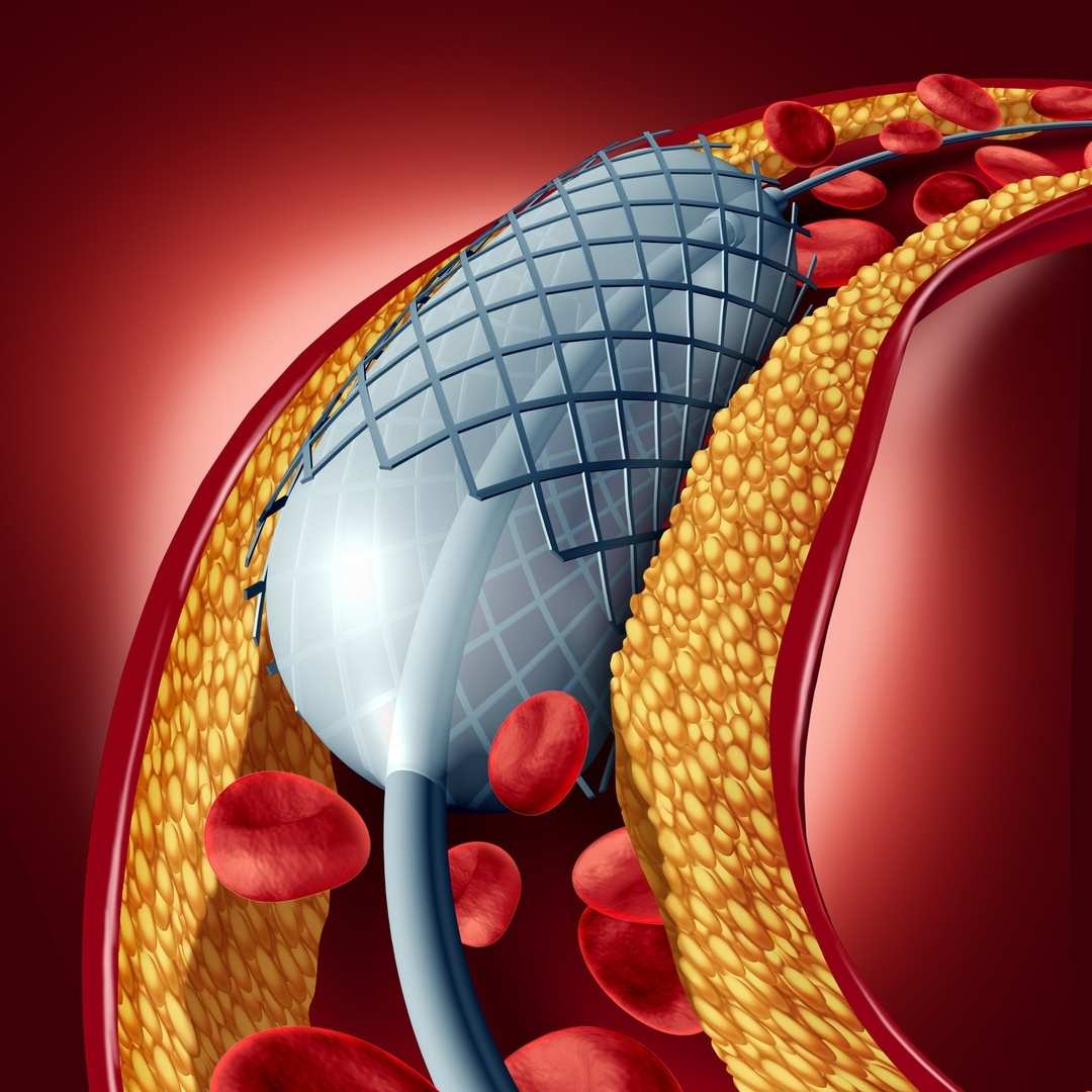 AngKoronararterie mit schematischer Darstellung einer Stentimplantation in eine Stenose